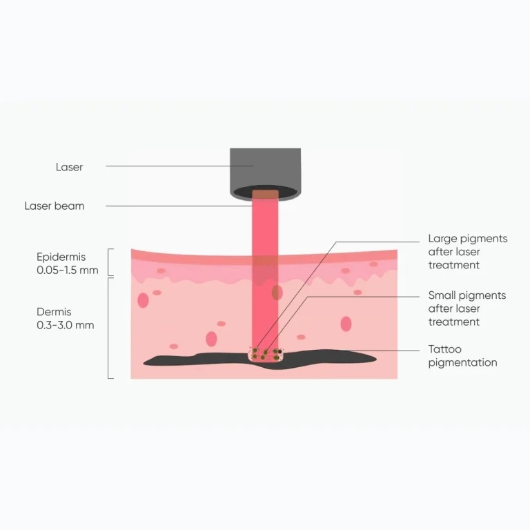 Zemits YAGenix Q-Switch Nd: YAG Laser 1064nm/532nm | Esthetic Spa