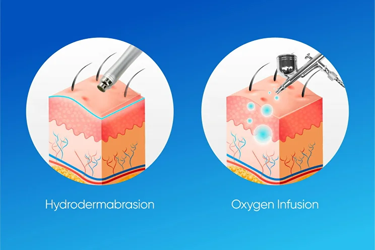 HydroLuxx Hydrodermabrasion & Oxygen Infusion System for Sale at