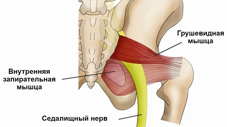 Ишиас седалищного нерва: симптомы, лечение и профилактика | Клиника Temed