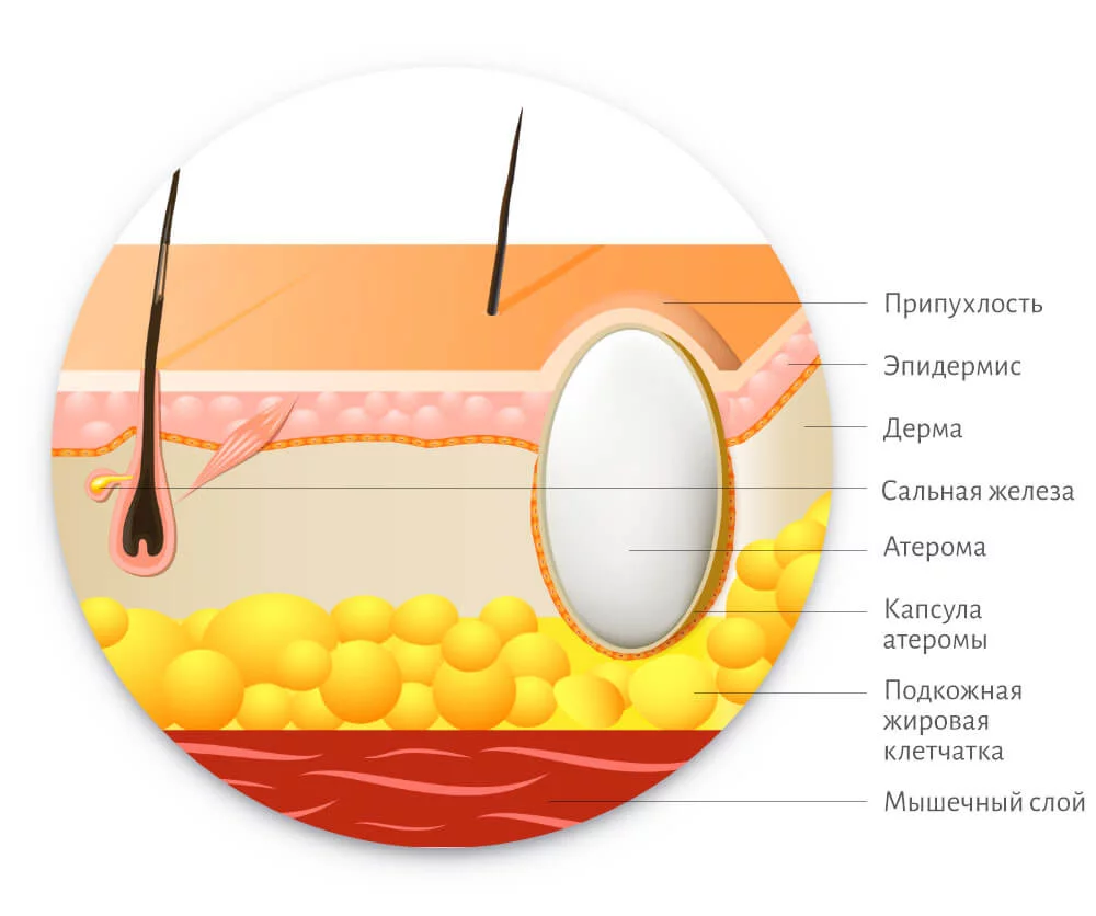 Атерома (закупорка сальных желез) - причины, симптомы, лечение