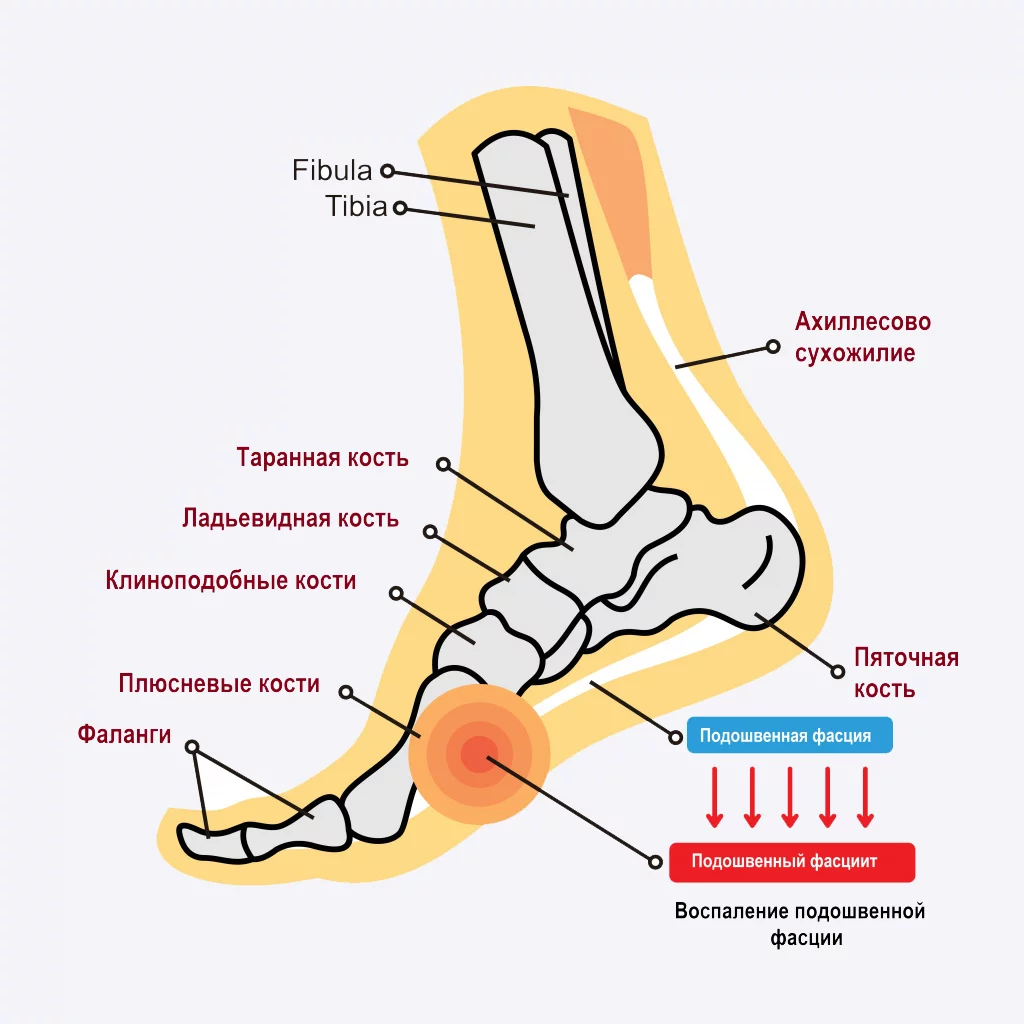 ТЕЙПИРОВАНИЕ ПРИ «ПЯТОЧНОЙ ШПОРЕ»