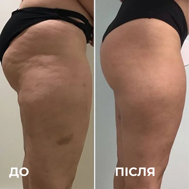 до та після — Марина, 42