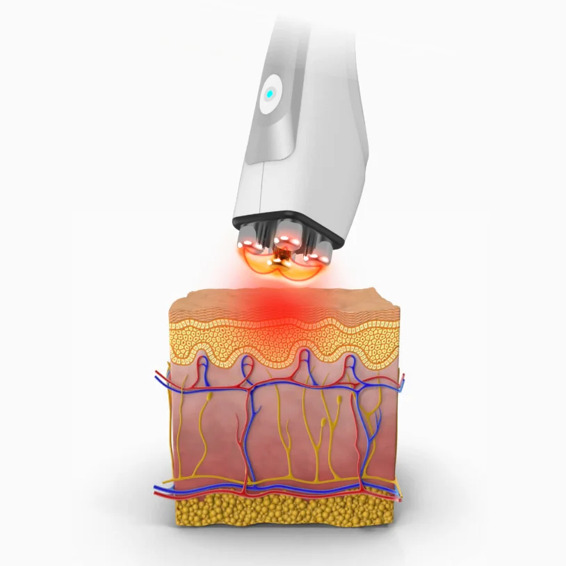 Zemits CrystalFrax Pro New Generation Fractional RF System