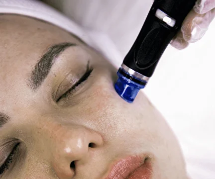 RF Microneedling